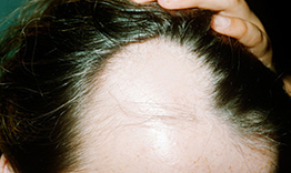 干细胞治疗头发再生,干细胞治疗脱发