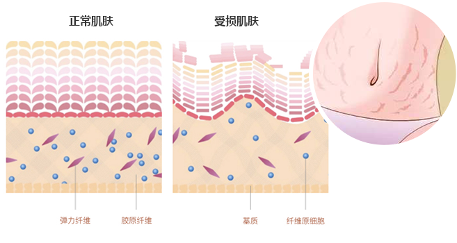 了解妊娠纹,多效因子修复妊娠纹,祛妊娠纹